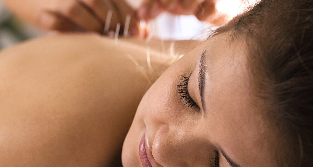 Akupunktur Behandlung